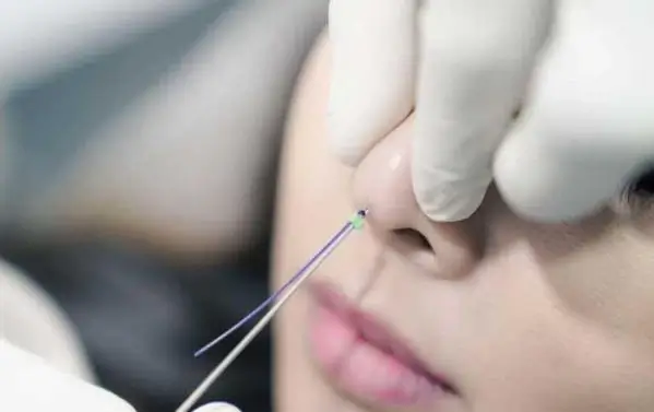 nâng mũi chỉ collagen