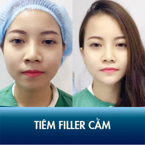 tiêm filler cằm vline
