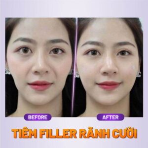 xóa nhăn rãnh cười