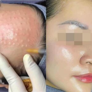 tiêm mesotherapy căng bóng