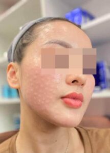 tiêm mesotherapy căng bóng