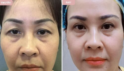 nâng cung chân mày