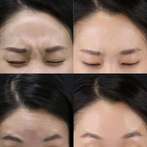 xóa nhăn ấn đường