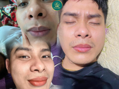 khử thâm môi cho nam