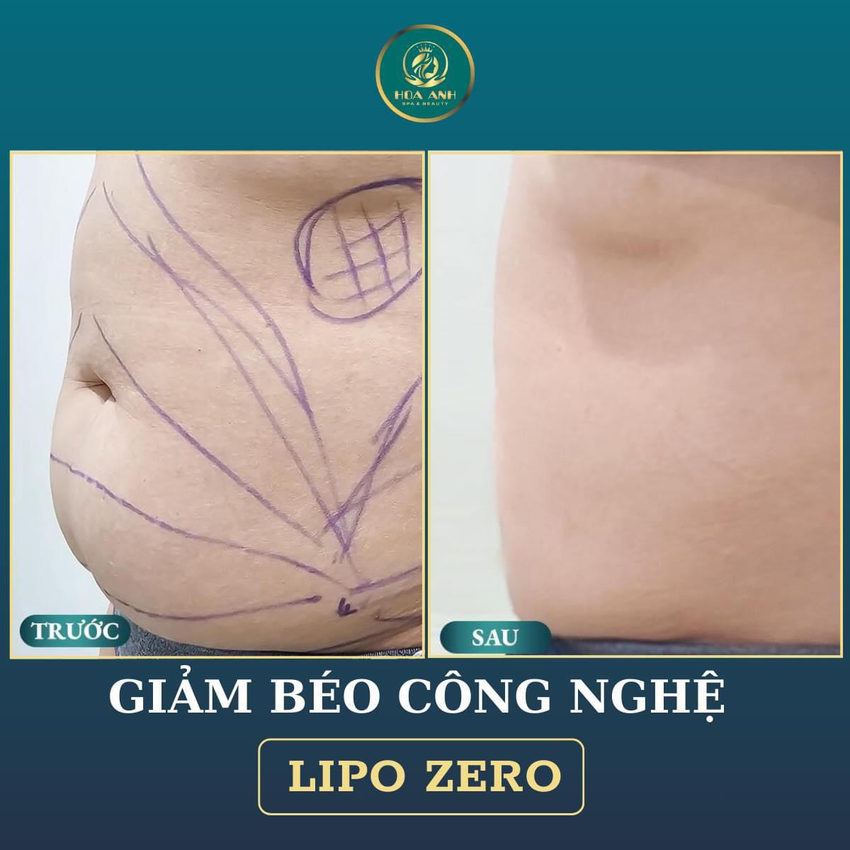 giảm béo lipo zero