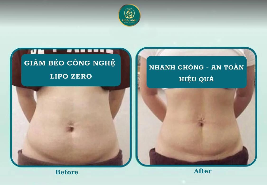 giảm béo lipo zero
