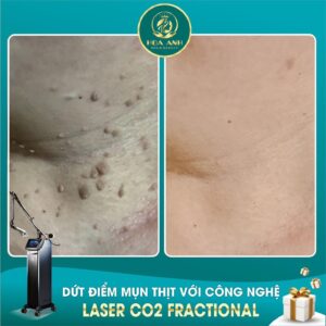 xóa mụn thịt bằng laser