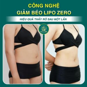 giảm béo lipo zero