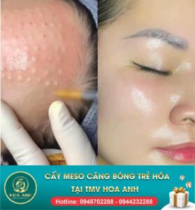 cấy meso căng bóng da