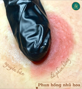 phun hồng nhũ hoa