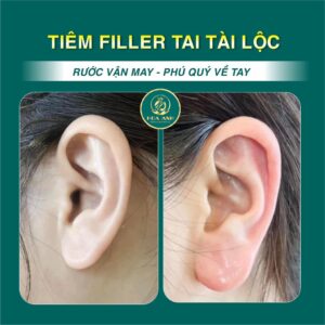 tiêm tai tài lộc