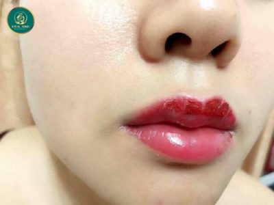 môi nổi mụn nước