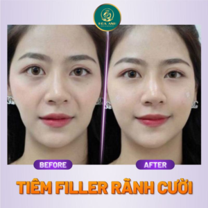 xóa nếp nhăn rãnh cười