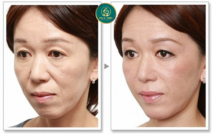 xóa nếp nhăn rãnh cười