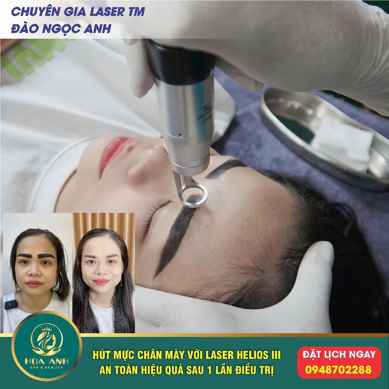 laser xóa mày