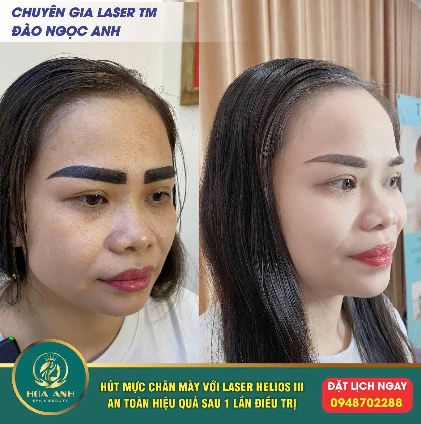 laser xóa mày