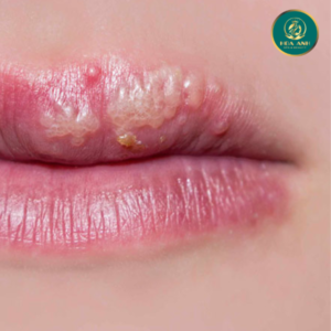 mụn nước môi logo