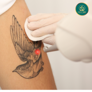 laser xóa hình xăm