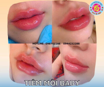 tiêm môi baby
