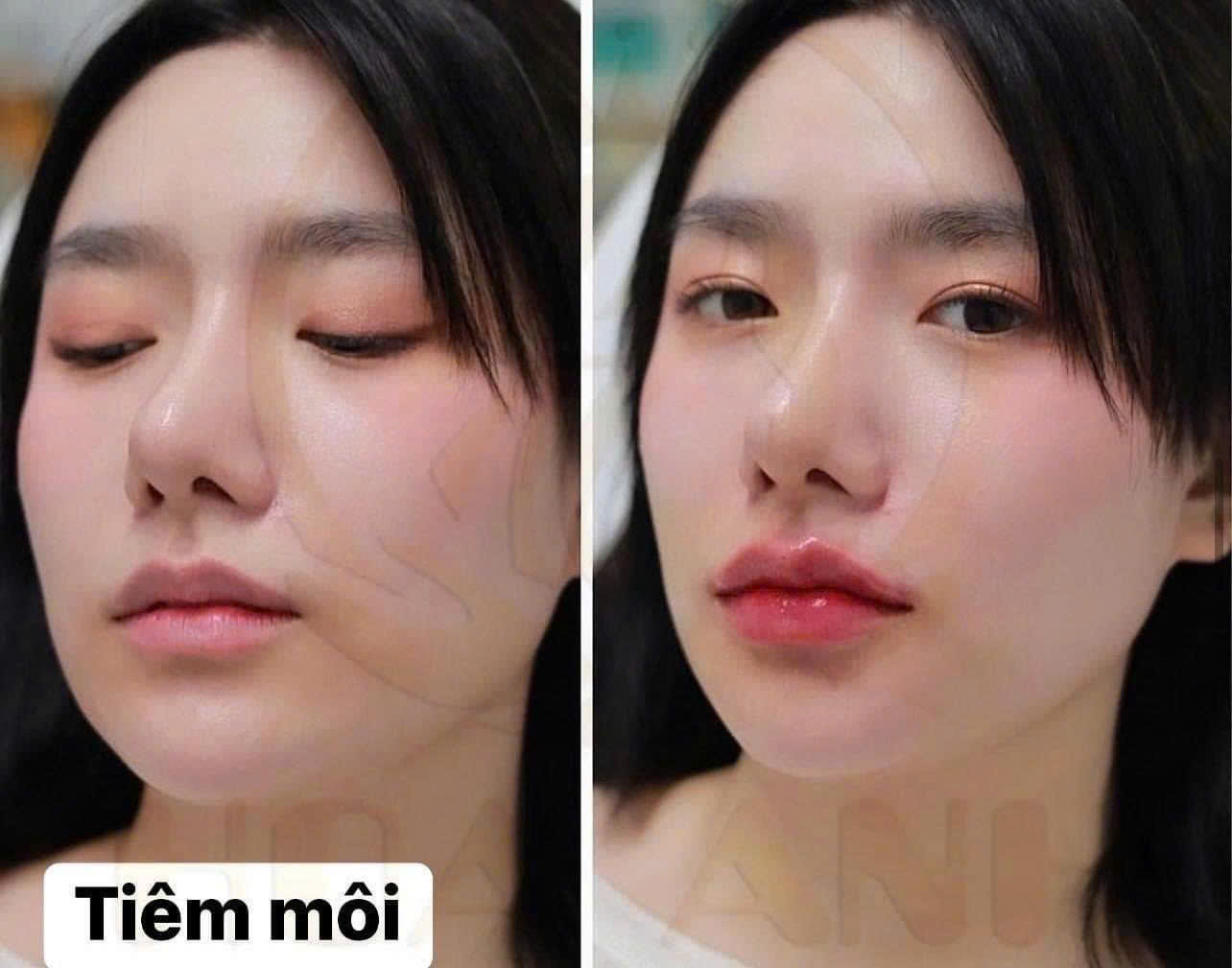 tiêm môi baby