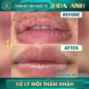 xử lý hạt bã nhờn