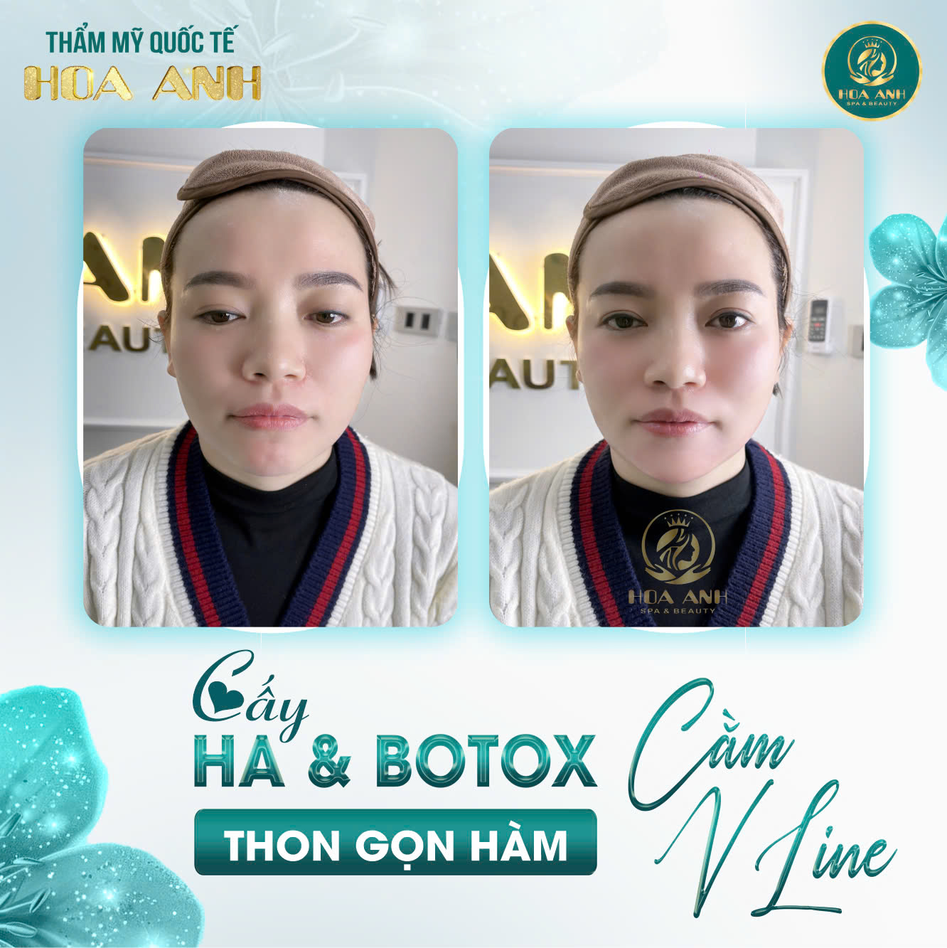 tiêm cằm vline