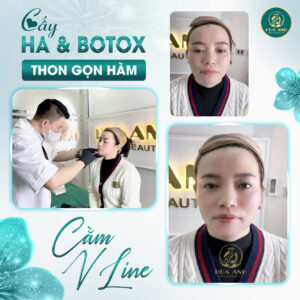 tiêm cằm vline