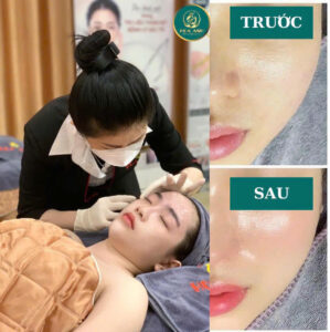 Cấy meso căng bóng