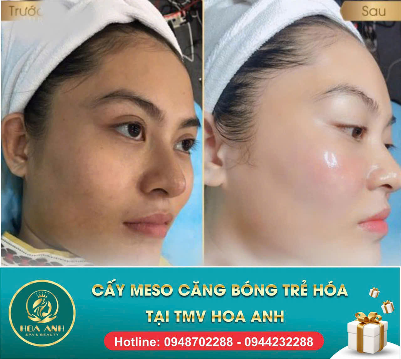 tiêm meso căng bóng da