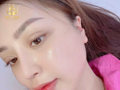 meso da căng mướt