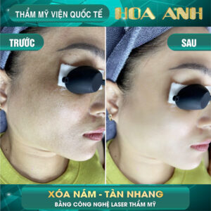 điều trị nám