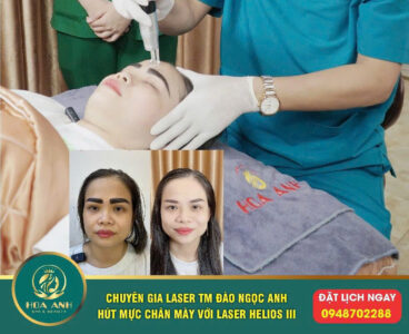 laser xóa mày hỏng, trổ màu