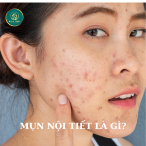 mụn nội tiết là gì