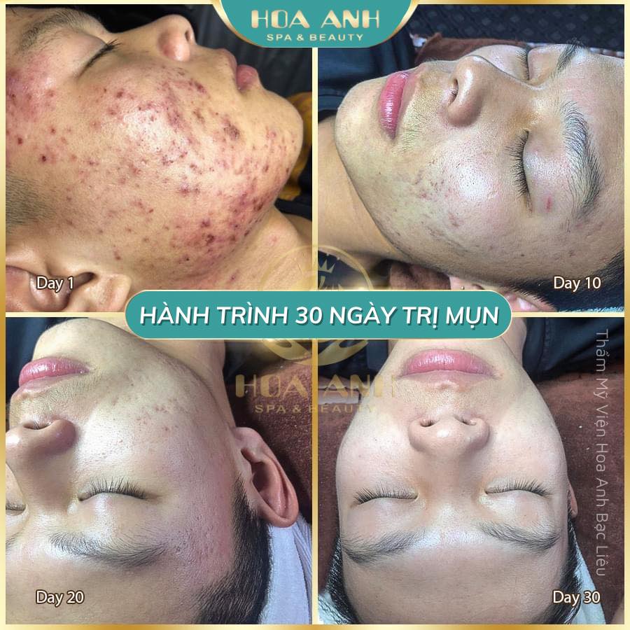 trị mụn