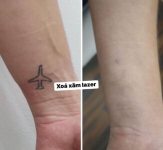 xóa hình xăm