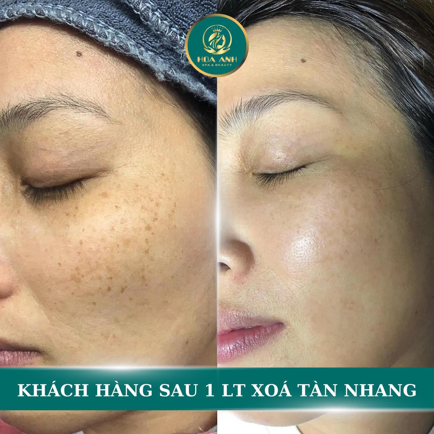 xóa tàn nhang