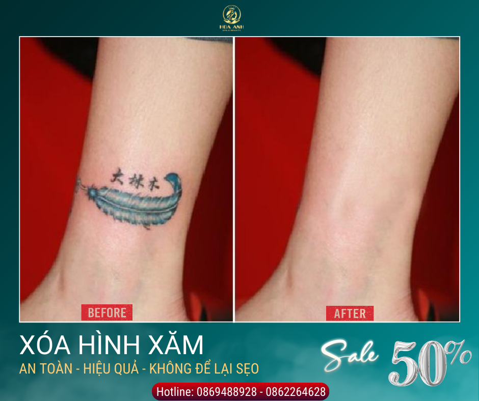 xóa hình xăm
