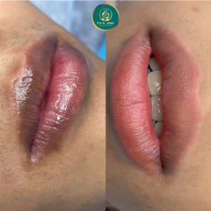 laser xử lý thâm