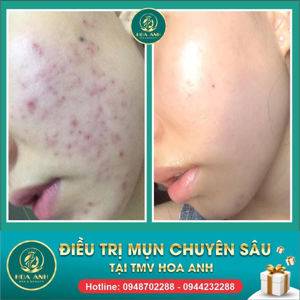 điều trị mụn