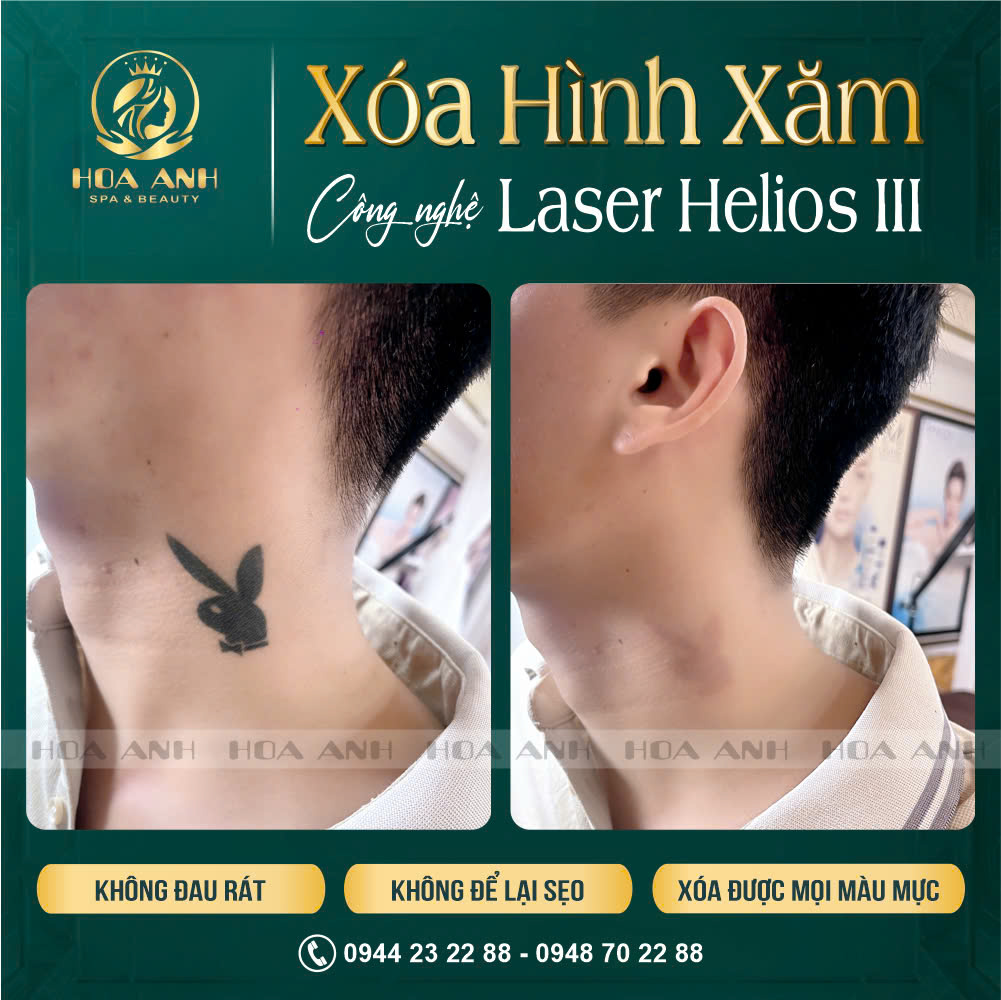 xóa hình xăm