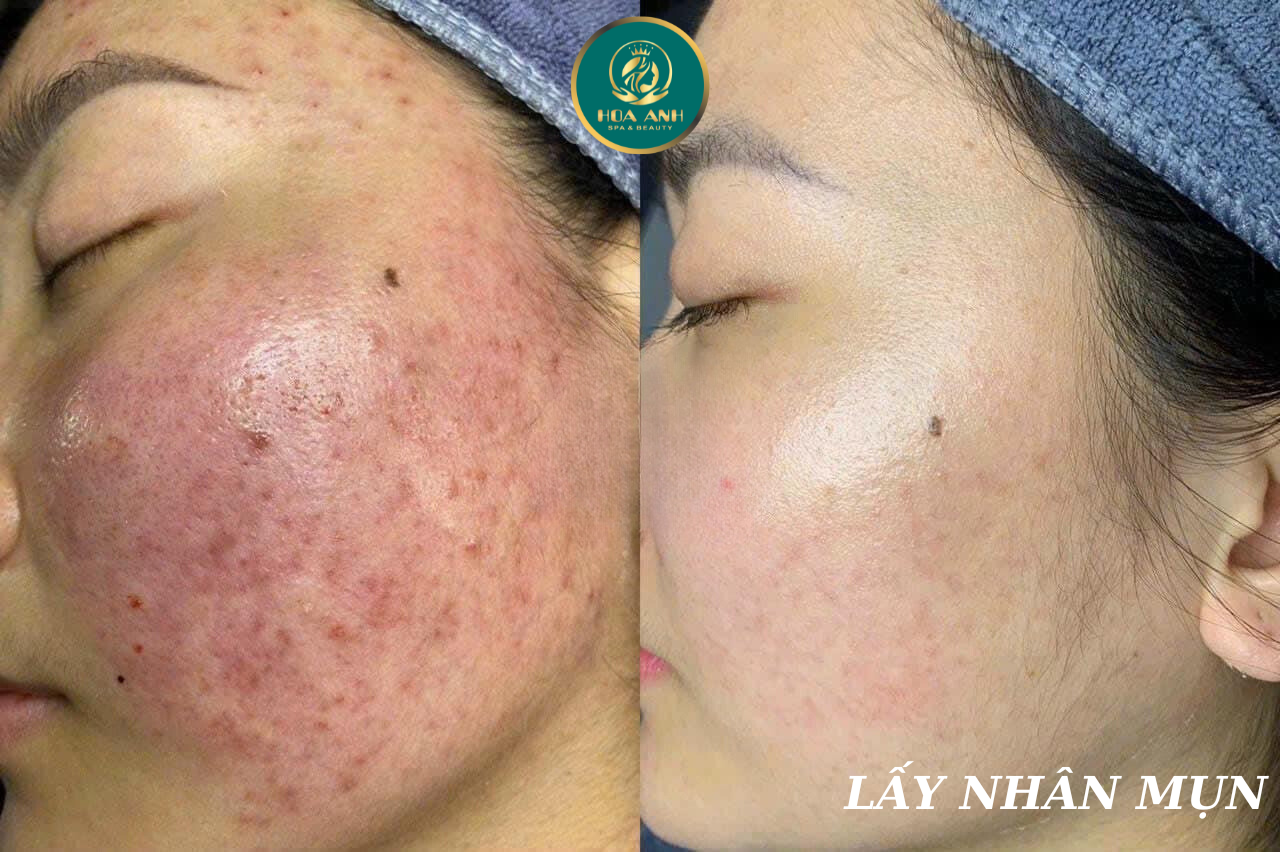 lấy nhân mụn