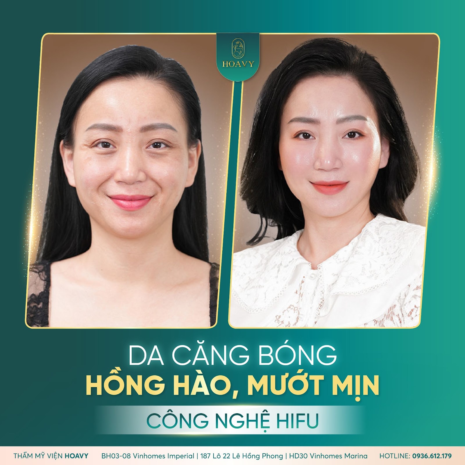 nâng cơ hifu