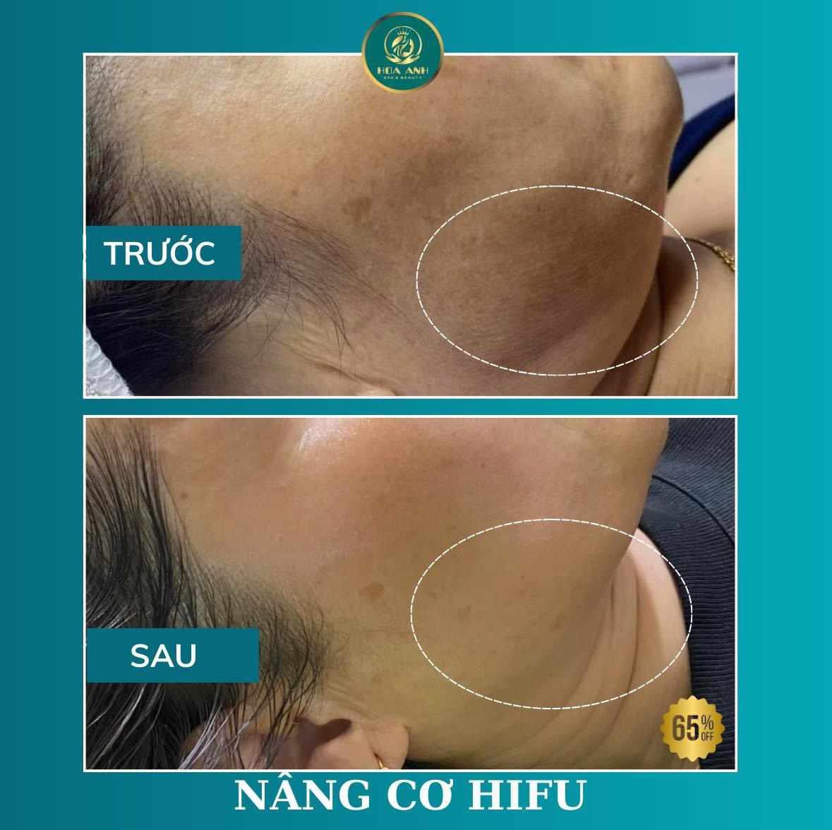 nâng cơ hifu