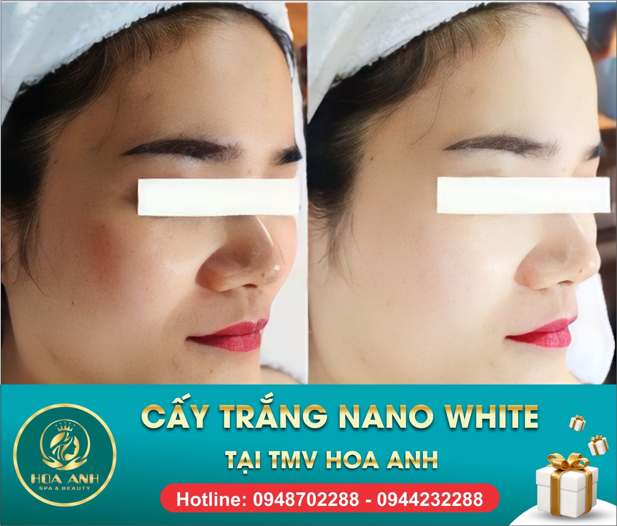 cấy trắng da