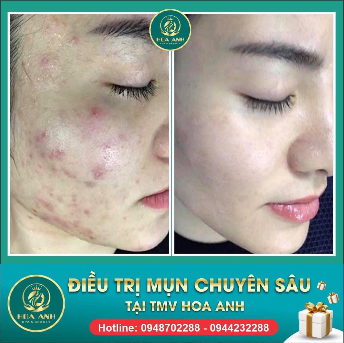 lấy nhân mụn