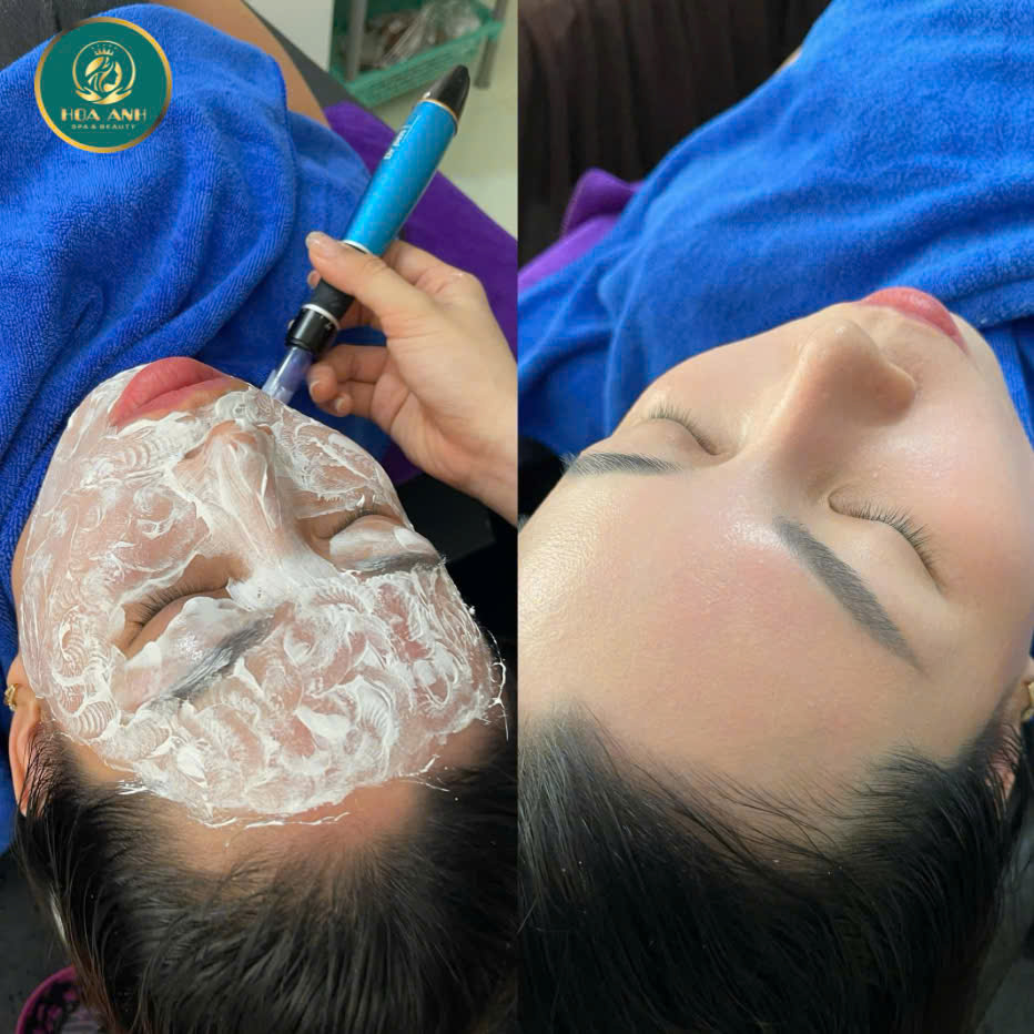 cấy trắng da mặt