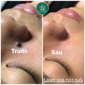 laser xóa nốt ruồi, mụn thịt