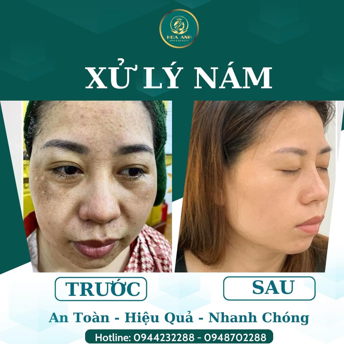trị nám