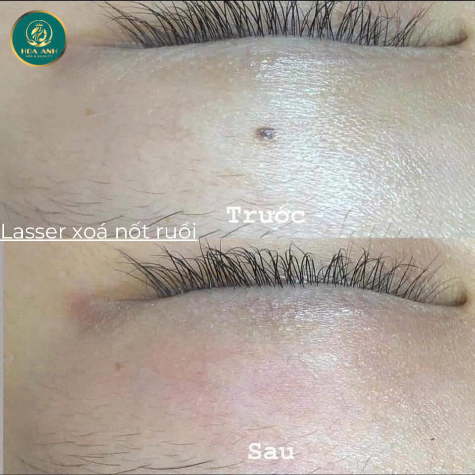 laser xóa nốt ruồi