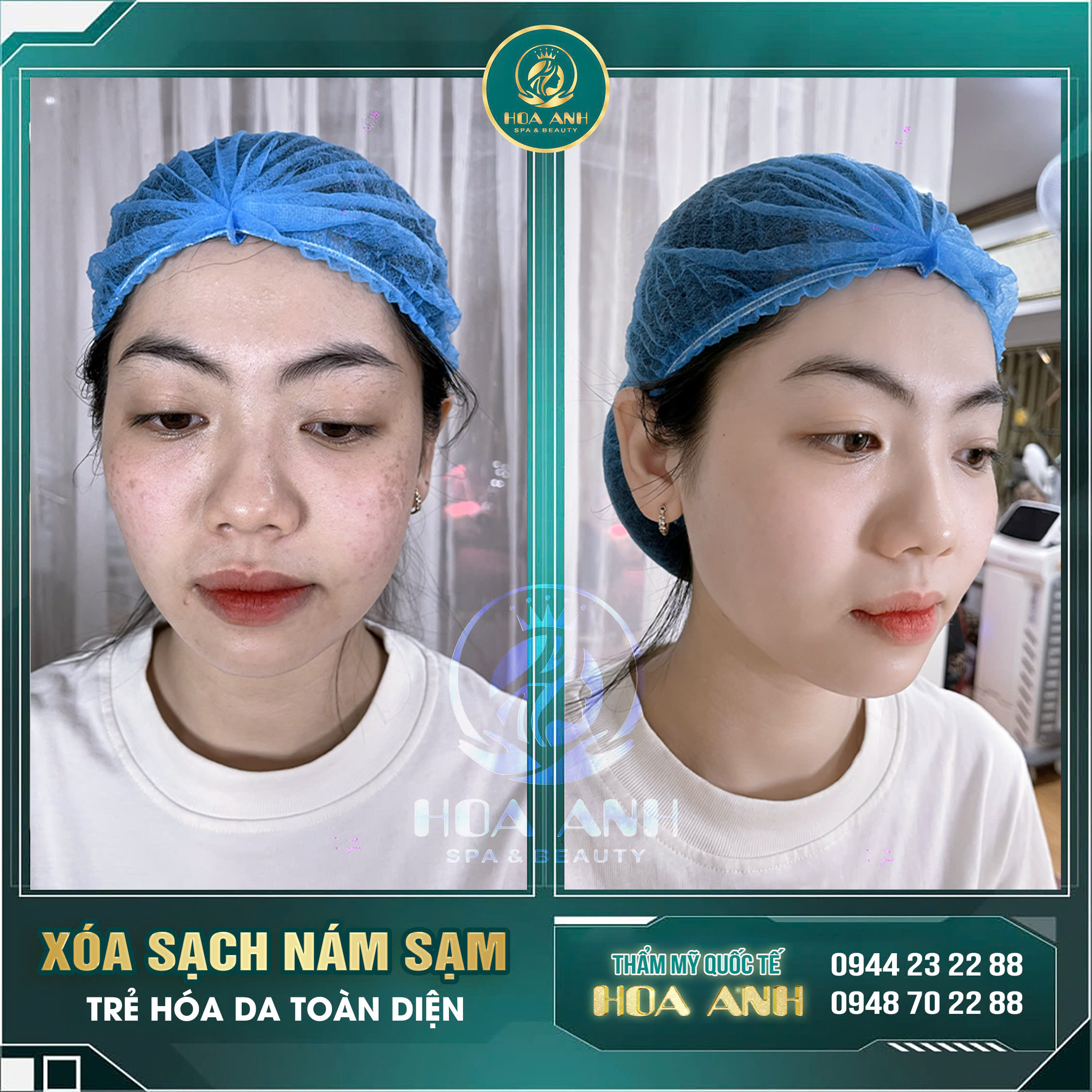 trị nám